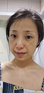 黄褐斑，明天又是水光的日子