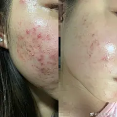 南宁祛痘分享:

介个就是我常说的，爱留痘坑的脓包豆还好姐妹才在爆发期就来问该怎么办了。

em...通常控制消炎自然是第一步，用比较温和的红蓝光。非剥落点阵阔以根据自身情况选择，比如毛孔大呀有点痘坑之类的。

✅姐妹现在的对比，是两个配合起来3次的x果。...展开全文c