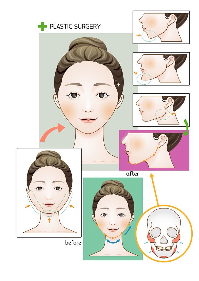 吸脂下颌缘瘦脸下面部整形头部骨骼医美整形...