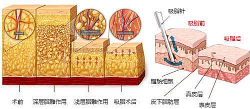 吸脂_百度图片搜索