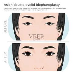 亚洲双眼皮成形术插画图片素材