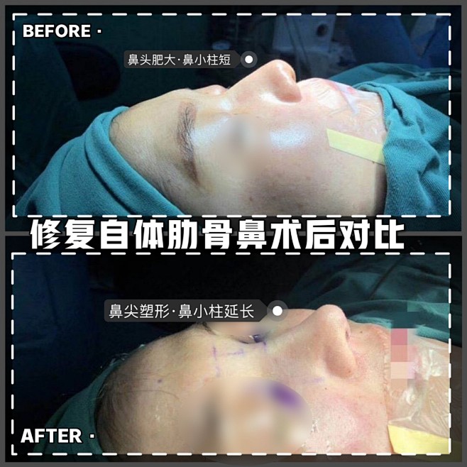 隆鼻案例对比