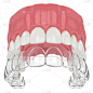 顶部,三维图形,牙齿矫正器,口腔卫生,健康保健,硅树脂,托架,牙医,塑胶,无形的