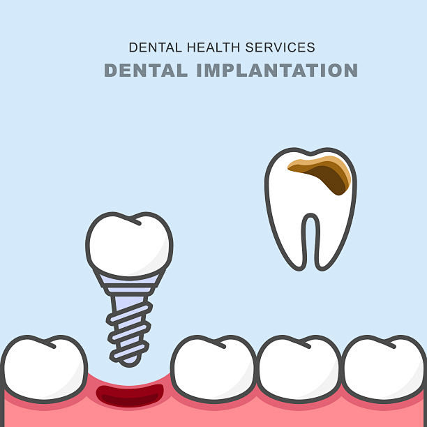 牙种植体代替龋齿 - 牙齿修复术矢量图素...