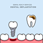 牙种植体代替龋齿 - 牙齿修复术矢量图素材