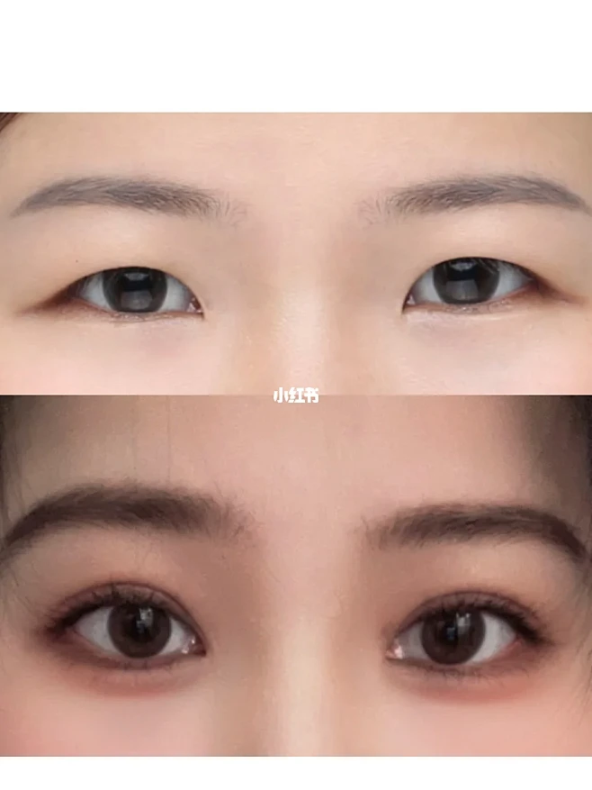 双眼皮一年前后对比发现