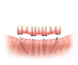图片：All-on-4 PA Dental Implant | All on Four PA Fixed Dentures : 在 Google 上搜索到的图片（来源：drsamkhoury.com）
