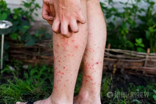 男子抓痒用手，腿，瘙痒，医疗保健和医学的概念-花瓣网