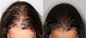 tratamiento para la alopecia femenina