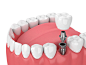 3d呈现器的下巴与牙齿和牙科磨牙植入物图片素材-图片ID：317865969