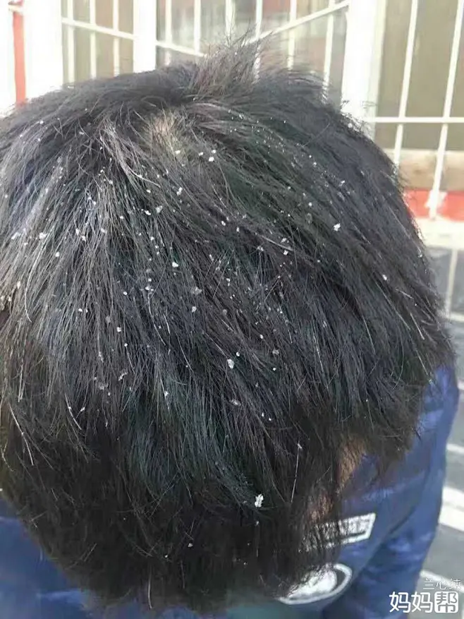 头皮屑的搜索结果_360图片-花瓣网
