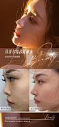 医美隆鼻案例对比图