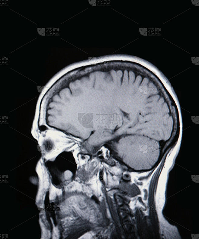 医学MRI图像显示大脑和头骨