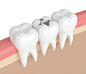 3d渲染的牙齿与银汞合金填充图片素材-图片ID：312909730