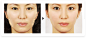 輪郭の美容整形(エラ、あご、頬骨、額)｜リッツ美容外科