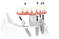 图片：All-on-4 Implant Dentures | Keller Family Dental | Keller, TX : 在 Google 上搜索到的图片（来源：kellertoothdoctor.com）