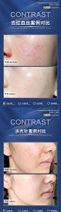 医美案例术后对比海报-源文件