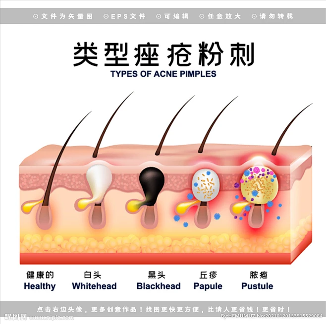 医学皮肤痤疮粉刺解剖图-花瓣网