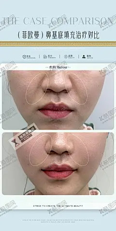 医美案例对比鼻基底填充法令纹对比 【酷图网】海报,医美,案例对比,整形,玻尿酸,瘦脸,
