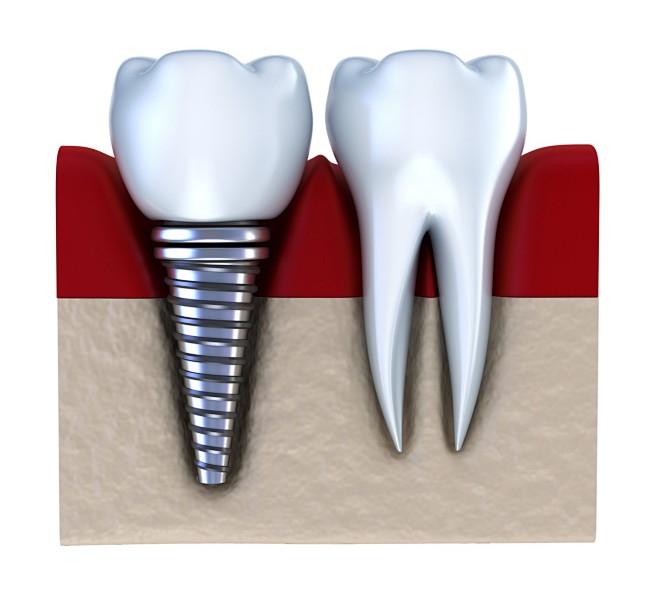 全部尺寸 | dental implan...