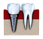 全部尺寸 | dental implants | Flickr - 相片分享！
