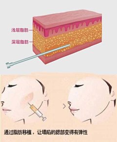面部吸脂和自体脂肪填充能同时进行？（点击关注@徐志_圈子-新氧美容整形