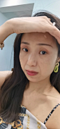 黄褐斑，明天又是水光的日子