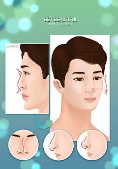 脂肪隆鼻手术术式鼻部整形男士医美整形插画脂肪|鼻部整形|男士|整形|插画