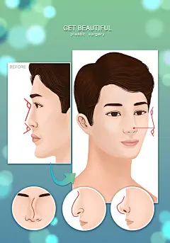 脂肪隆鼻手术术式鼻部整形男士医美整形插画脂肪|鼻部整形|男士|整形|插画