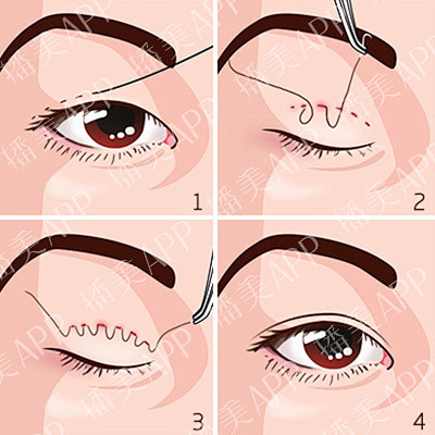 埋线双眼皮
