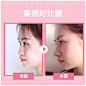 【埋线隆鼻】华美19周年庆，线雕隆鼻，无需手术，即刻高“鼻”格，五分钟打造网红混血小翘鼻！_整形优惠预约-新氧美容整形