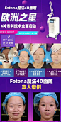 刚刚做完#Fotona4D#的小姐姐
✅眼周细纹减少、眼袋改善
✅法令纹淡化明显
✅面部肌肤饱满上提
✅下颌缘轮廓清晰
期待她1个月后的蜕变哟
#武汉美莱# 2武汉·楚河汉街 L武汉美莱医学美容医院的微博视频 ​​​​