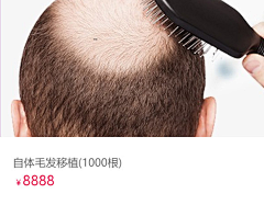 标志君采集到毛发移植
