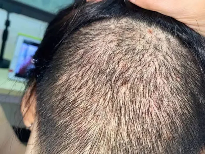 【日本监制】头部头皮毛囊炎专用喷雾剂治头皮溢脂性皮炎特校药头皮脱屑痒头上长红疙瘩后脑勺痒脖子痘痘AZ 【单盒装】毛囊炎专用喷剂【图片 价格 ...