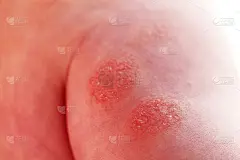 儿童特应性皮炎