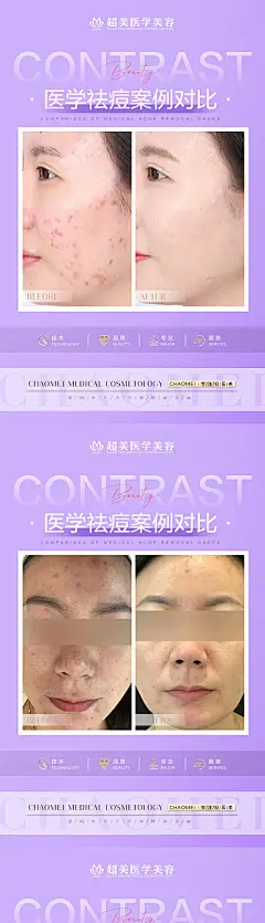祛痘案例对比海报-源文件