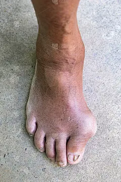 大脚趾关节的痛风炎症和指甲真菌感染