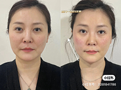 艾兰艾兰采集到医美案例