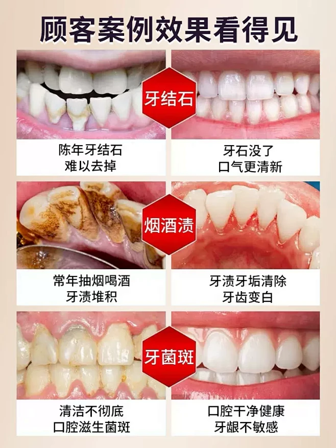 超声波冲洗牙结石去除器洁牙仪牙石牙垢污渍...