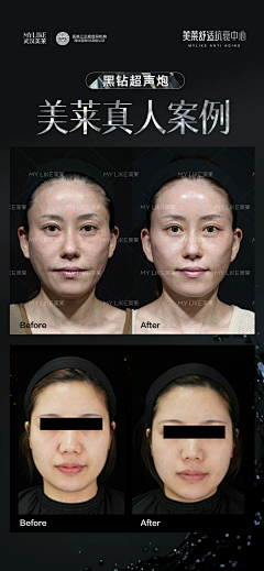阿球不是球采集到医美案例