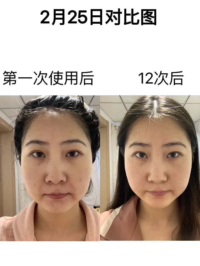 去法令纹对比图 - 小红书搜索-花瓣网