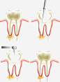 补牙过程免抠png素材_新图网ixintu.com
