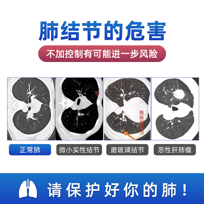 德国进口肺结节素胶囊护肺净肺膳丸清肺磨玻...