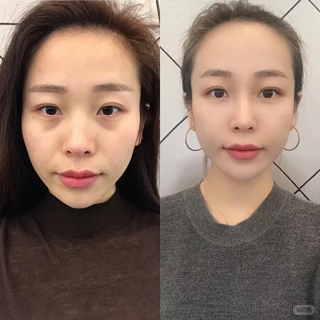 紧致抗皱对比图 - 小红书搜索
