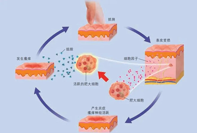 越挠越痒的“瘙痒-抓挠循环”机制。抓挠皮肤会使表皮受损。受损的表皮会释放出细胞因子，使肥大细胞和瘙痒神经活跃。活跃的肥大细胞释放出组胺，随着 ...