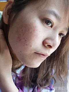 痘印是很多青春痘患者心头永久的痛，长痘的地方留下了深深浅浅的痕迹，甚至是疤痕。有不少有痘印的朋友都非常急切的想要祛除痘痘，食物对于淡化痘印也很有帮助。www.99sep.com下面笔者给大家介绍下吃什么能 祛痘 