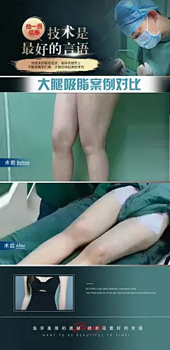腿部吸脂抽脂案例对比 海报-设计素材-shejisc.cn