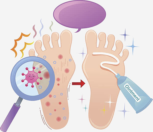 脚气矢量图免抠素材_图宝宝 https:...