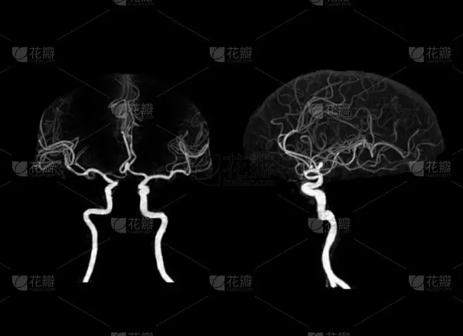 脑或CTA脑显示脑动脉的CT血管造影.图片_其他-图片图片素材-花瓣网
