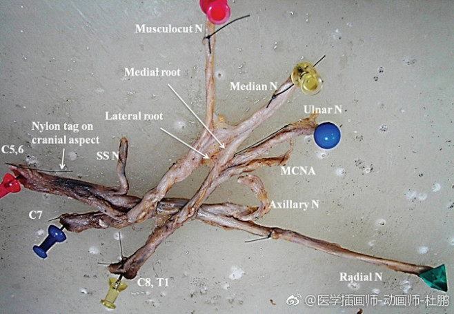 对臂丛神经的分支形貌的尸体解剖学研究A ...